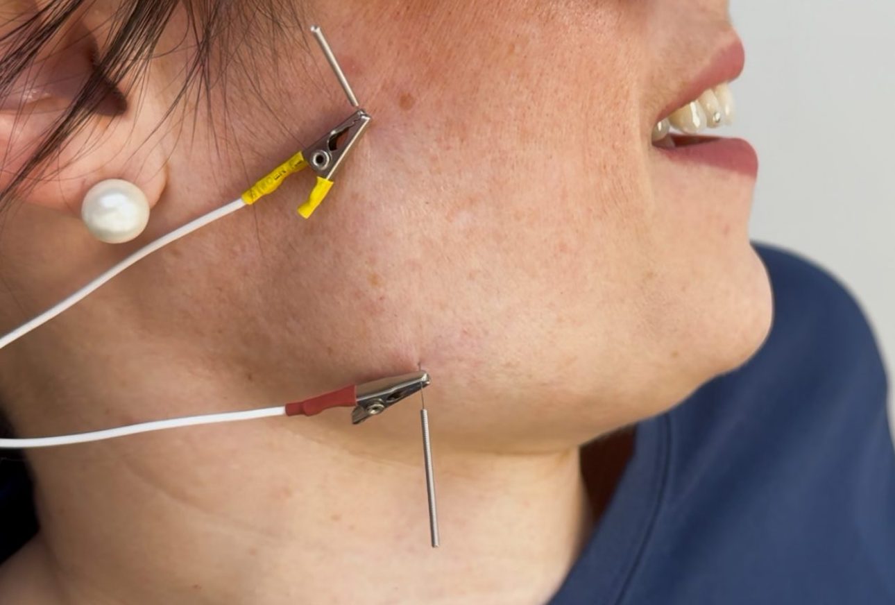 Dry Needling Nadeln an Wange von Patientin