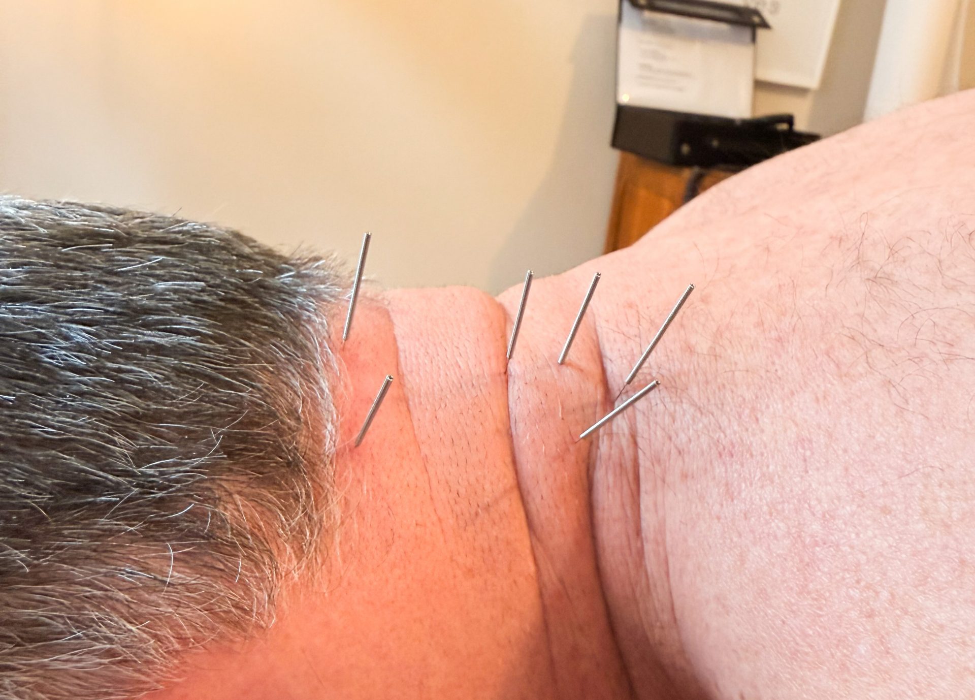 Dry Needling Nadeln im Nacken von Patienten